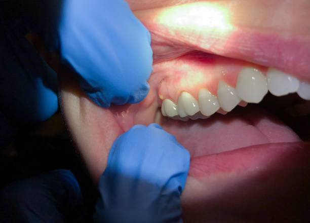 Best Emergency Dental Care for Sports Injuries in Lumberton, NC